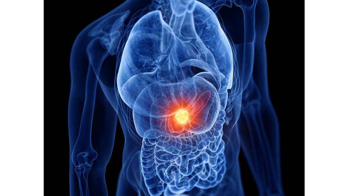 Brachytherapy Implant OncoSil May Improve Pancreatic Cancer Treatment