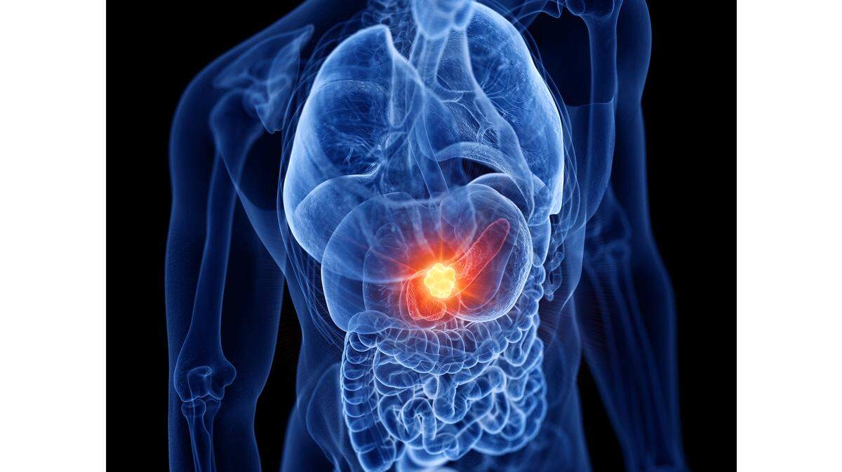 Brachytherapy Implant OncoSil