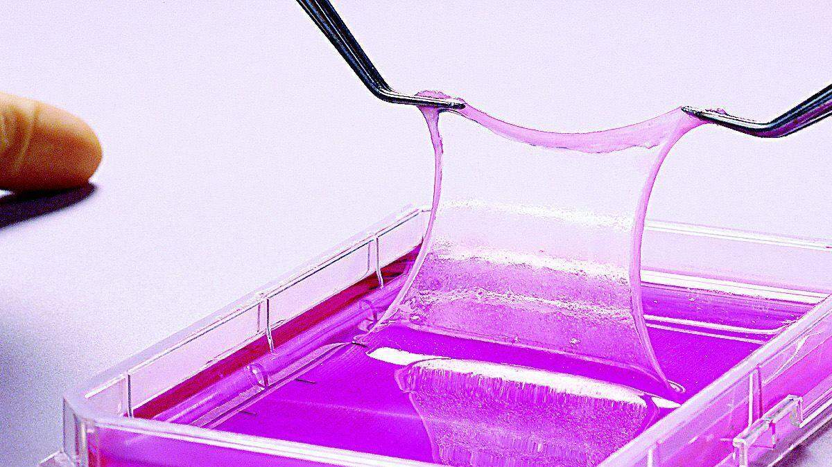 An example of an "Epicel graft," like those being used to treat Tega Cay burn victim Connor McKemey, is shown. Epicel grafts are see-through sheets of skin cells -- only two to eight cell layers thick -- that are grown from a small sample of a burn patient's own healthy skin. Because of the delicacy of the cultured grafts, up to 25 technicians are required to remove each graft from the flask it grew in.