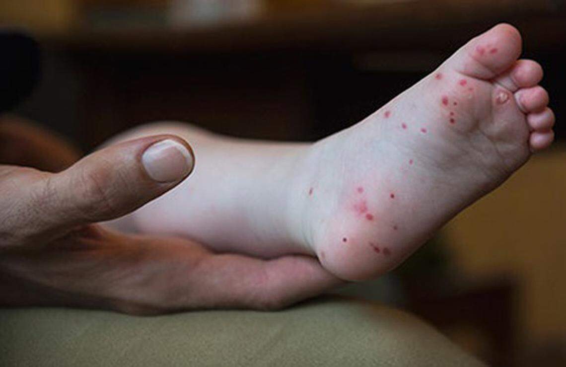 A rash of red spots or bumps is a sign of hand, foot and mouth disease.