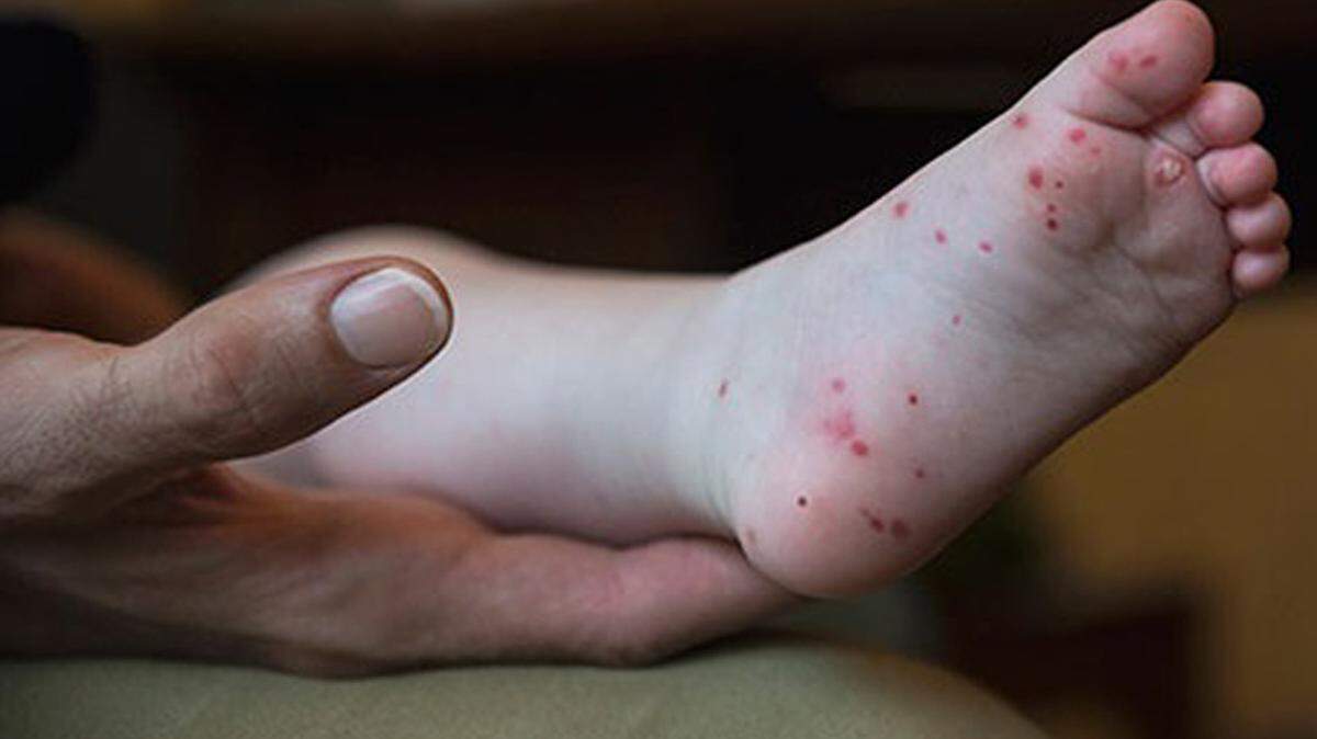 A rash of red spots or bumps is a sign of hand, foot and mouth disease, which is most common in children.