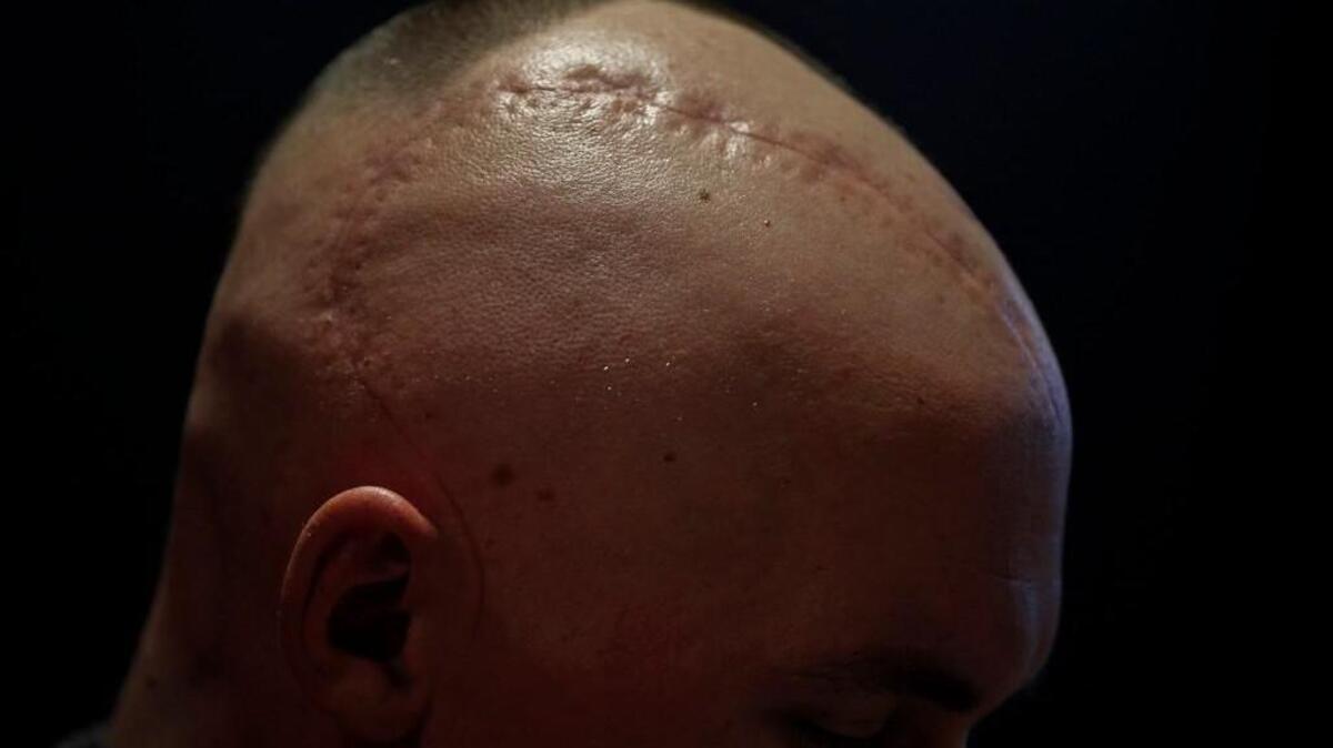 A scar from a brain surgery is seen on Chase Sims’ head at Prestonwood Baptist Church in Plano, Texas. The singles pastor at the Prestonwood, Sims is just 28.